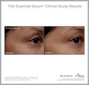 a tns advanced+ serum before and after photo of a 51 year old woman