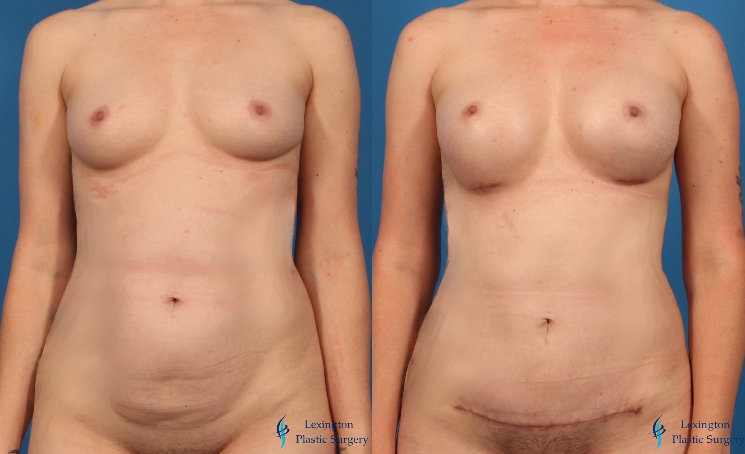 Abdominoplasty: Patient 1