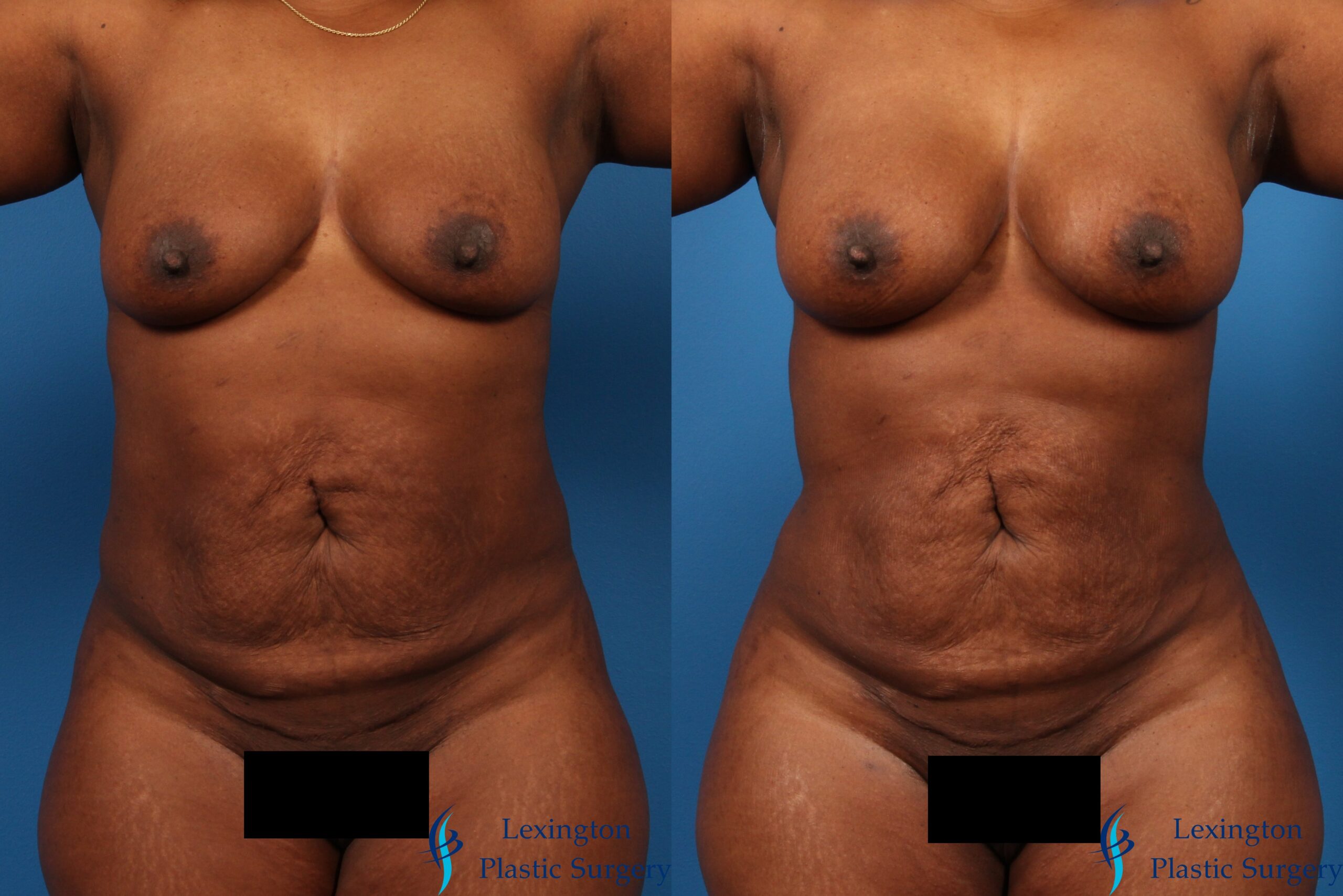 Liposuction: Patient 1