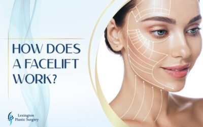 How Does a Facelift Work?