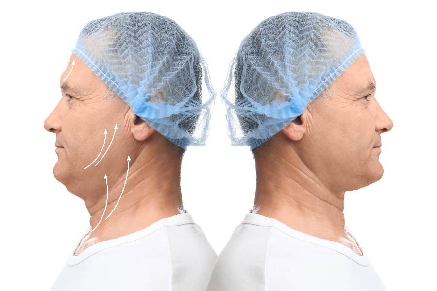 What to Expect Before, During, and After a Neck Lift Procedure