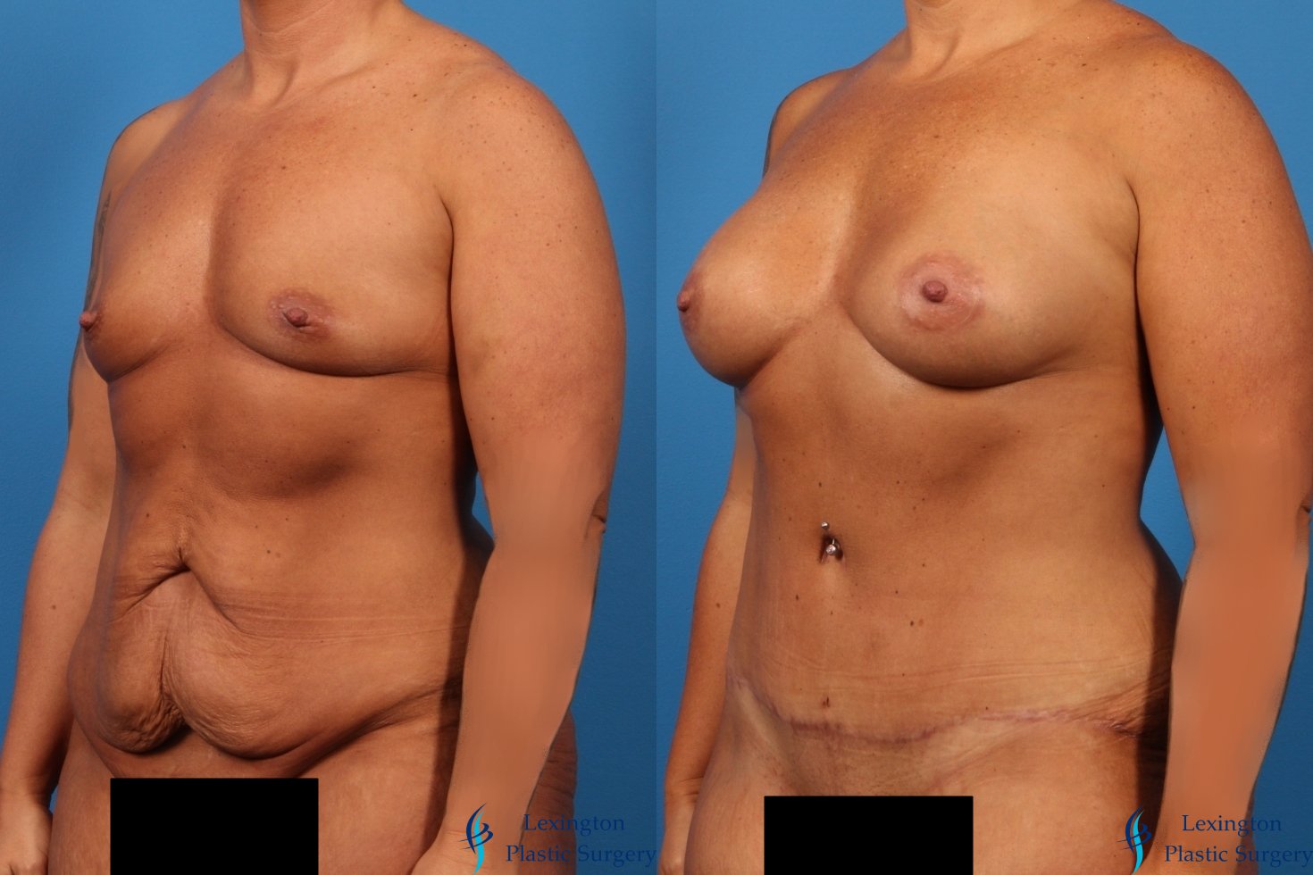 Breast Augmentation: Patient 2