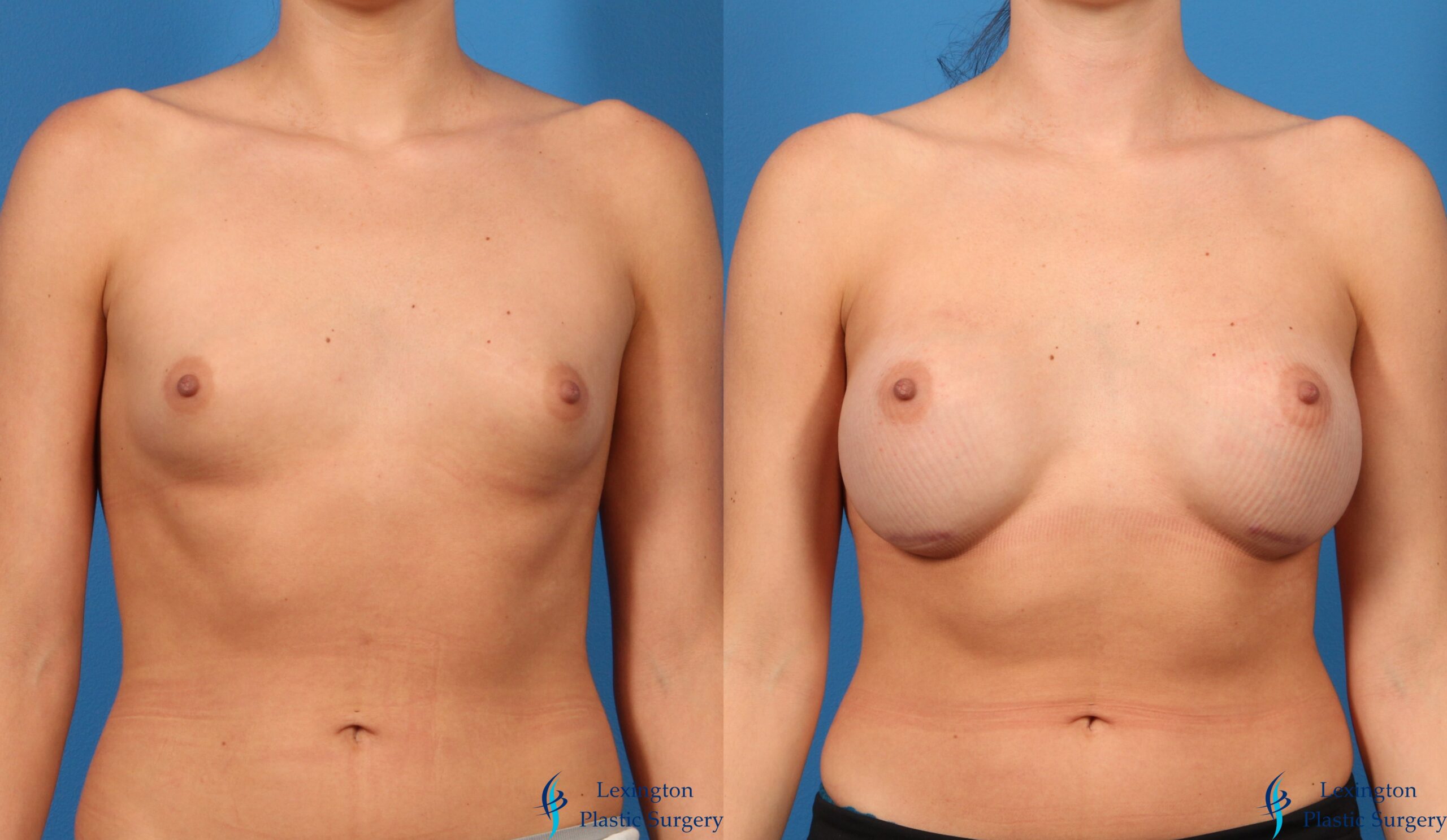 Breast Augmentation: Patient 13