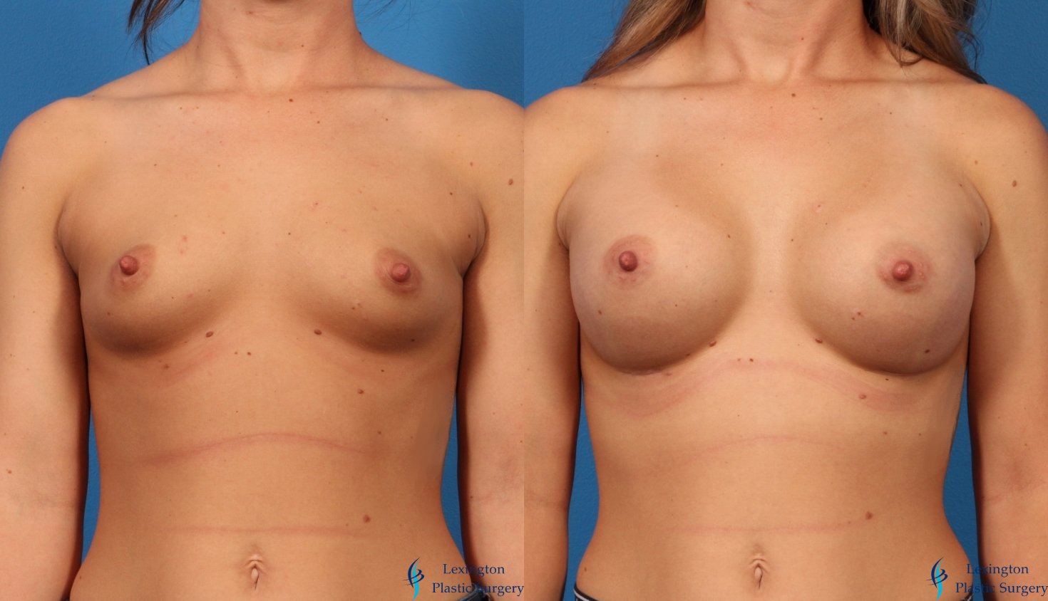Breast Augmentation: Patient 2