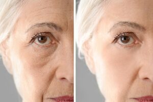 What Happens to Plastic Surgery When You Get Old