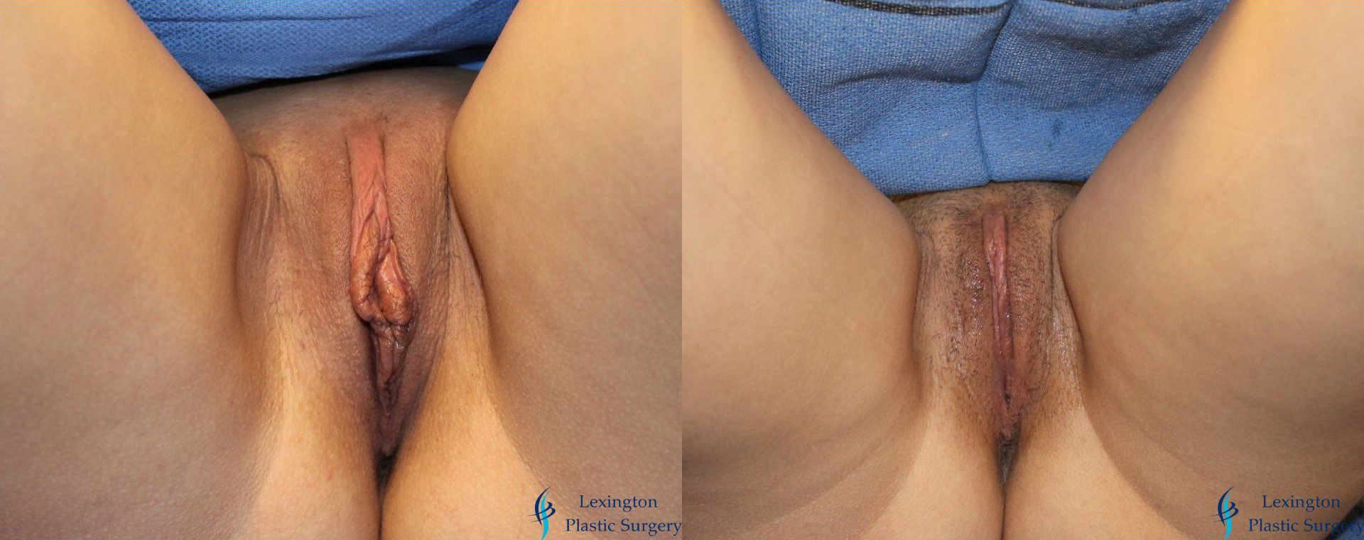 Labiaplasty: Patient 17