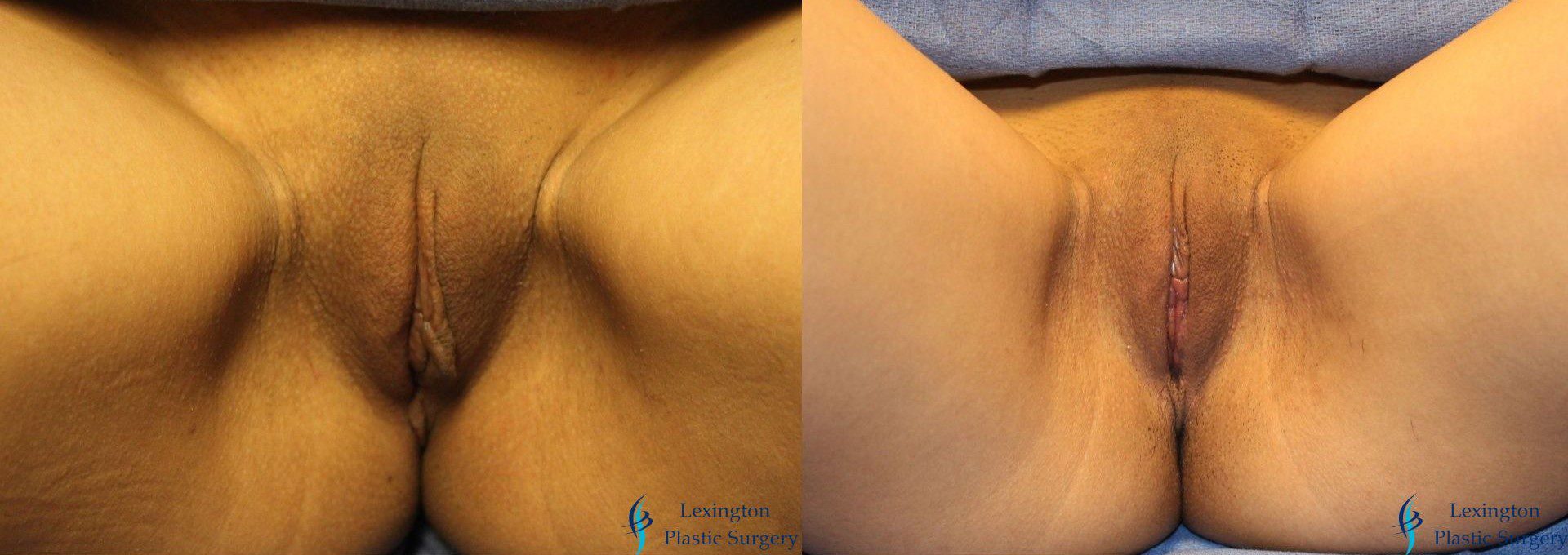 Labiaplasty: Patient 17