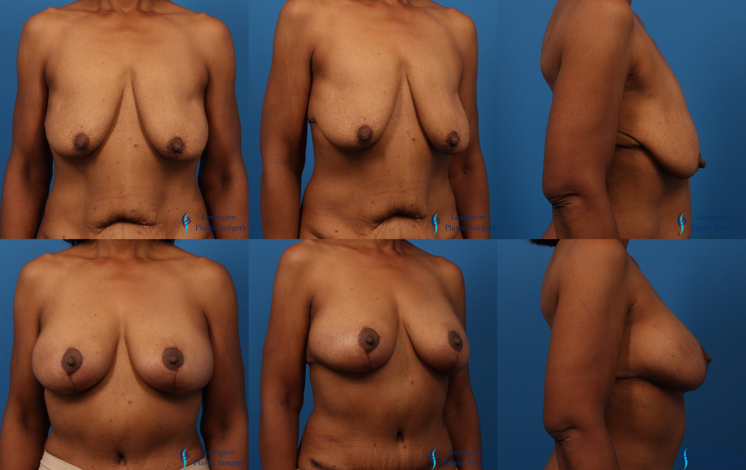 Breast Augmentation With Lift: Patient 4