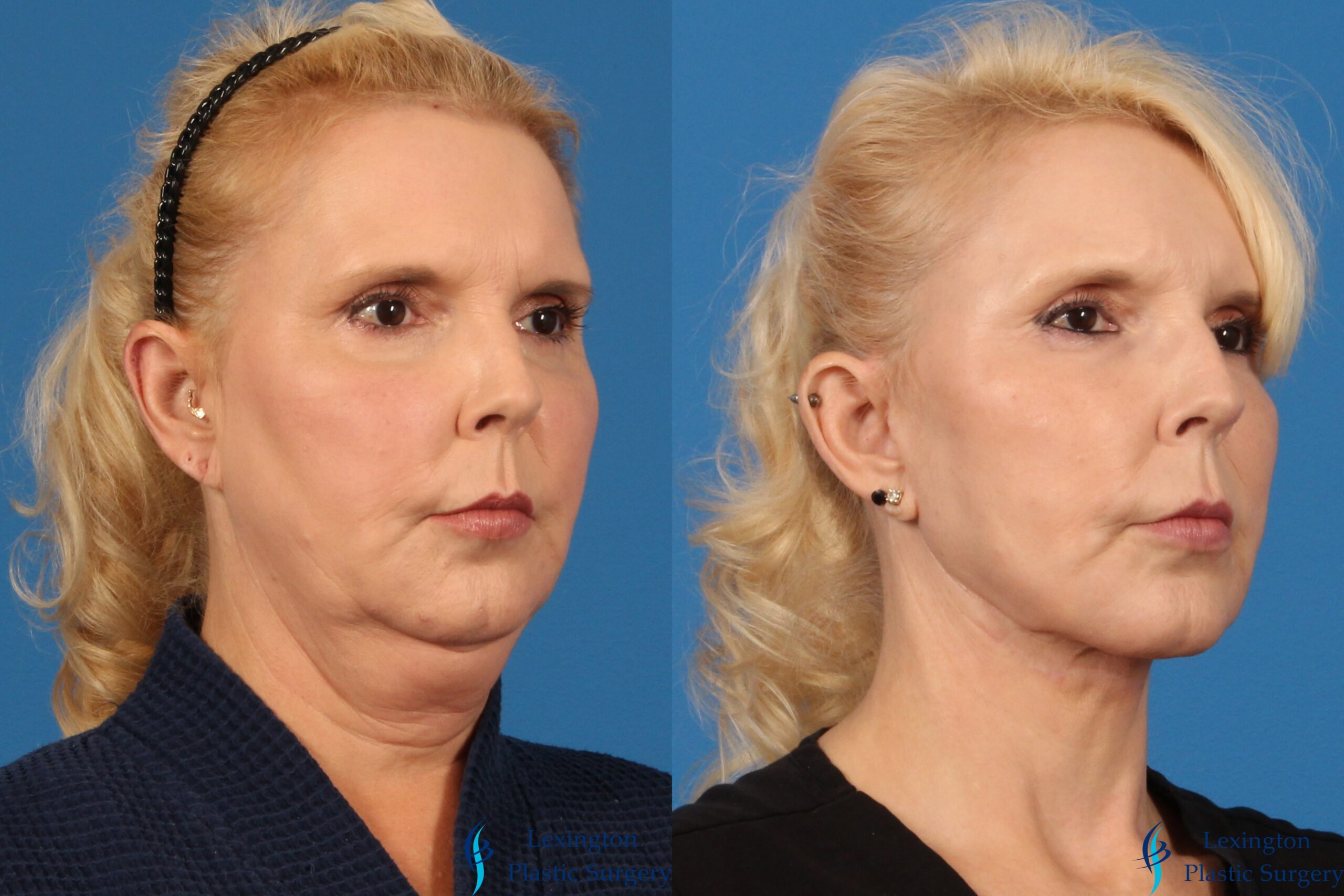 Neck Lift: Patient 1