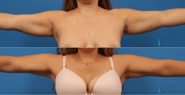 Untitled design Liposuction: Patient 3