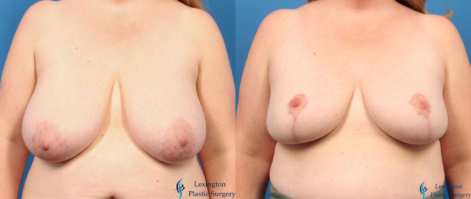 Breast Reduction: Patient 6