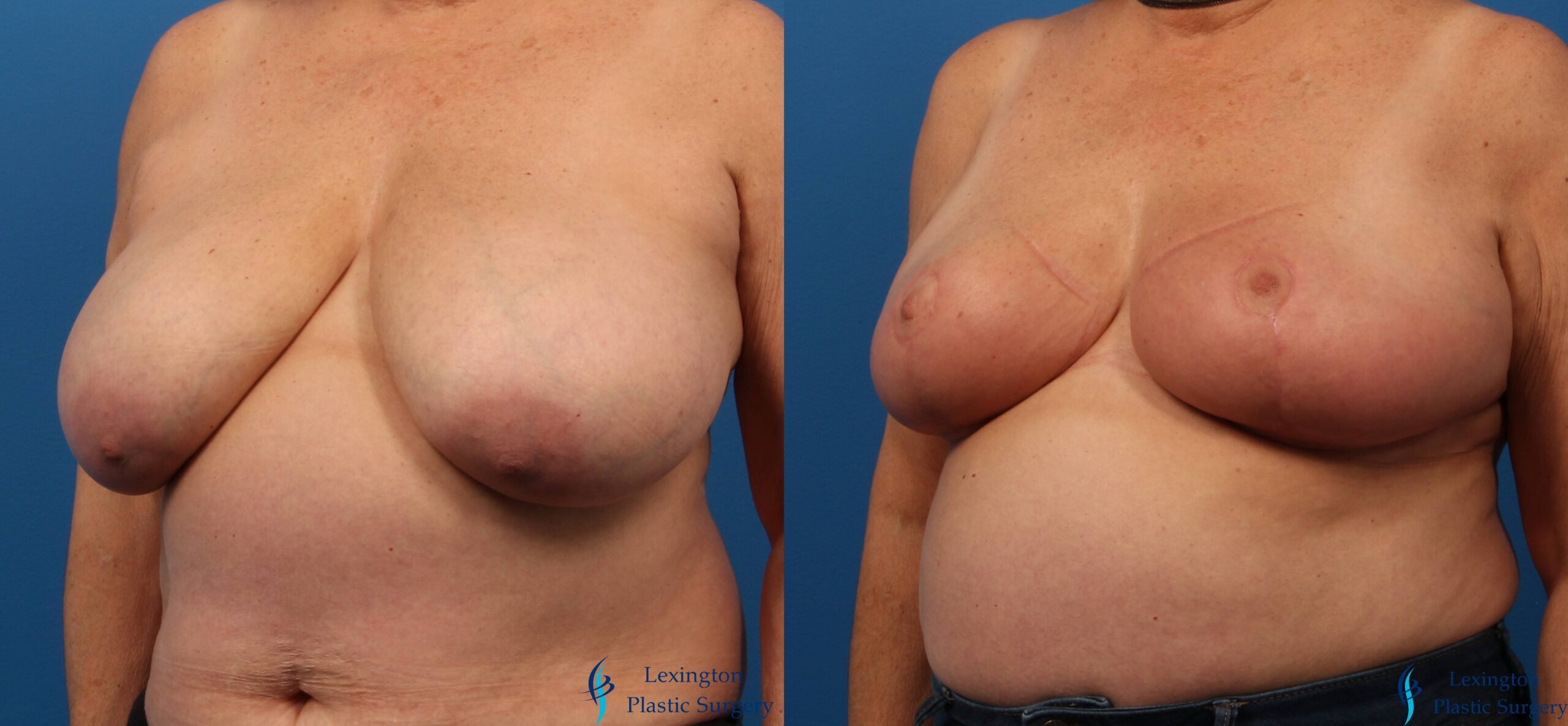 Breast Reduction Pt. 9 (2) Breast Reduction: Patient 1